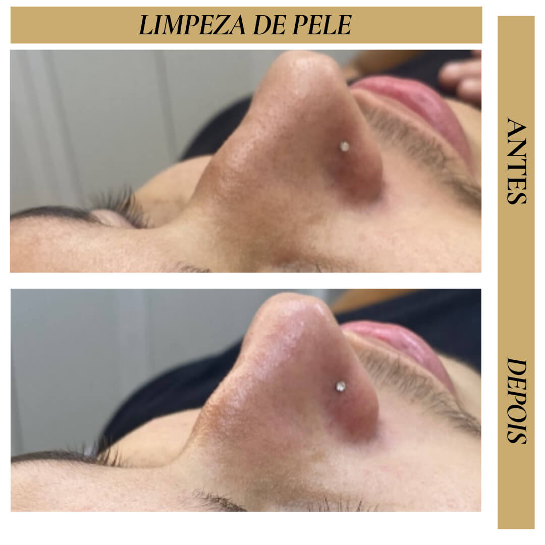 Antes e Depois - Limpeza de Pele